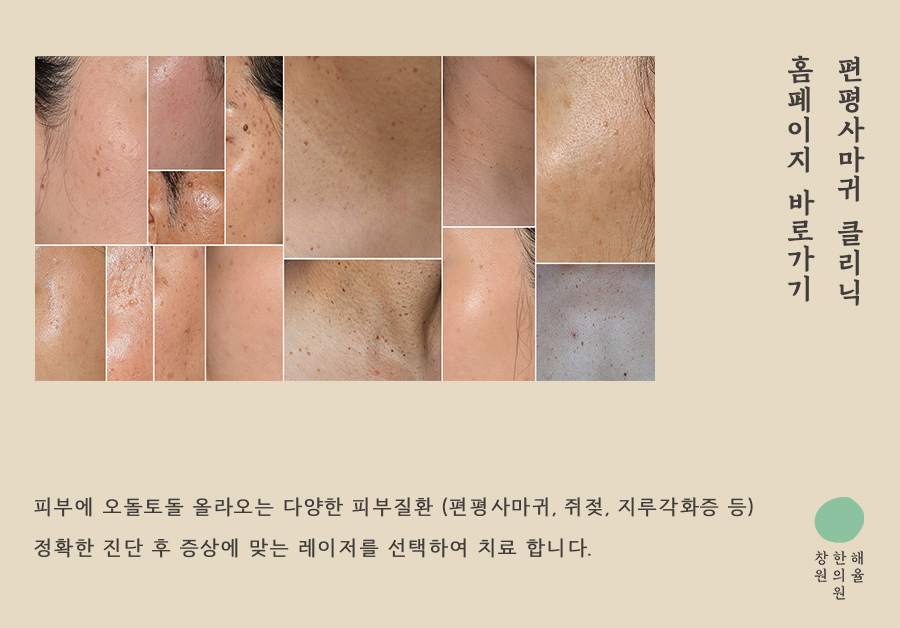 창원점 편평사마귀 제거 홈페이지 